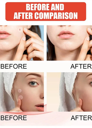 240pcs New Pimple Patch Acne Patches Heart/Star/Flower/Round Shape